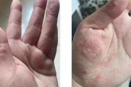 夏天手上长透明小水疱的原因及是否需要治疗