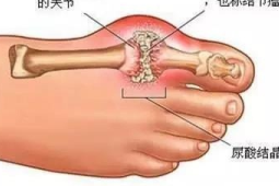 痛风祸根并非嘌呤我们对它的误解太深了