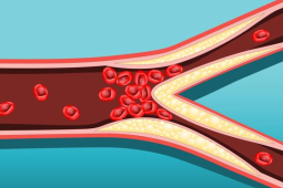 体检发现器官钙化就是大病征兆吗