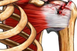 解码肩关节疼痛肩袖破裂还是肩周炎