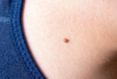 痣长错地方可能危及生命尤其要注意身体这些部位
