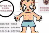 夏季战痘关键：保持皮肤正常呼吸