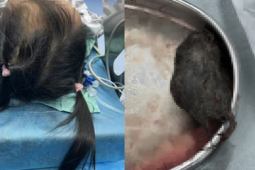 岁女孩胃中惊现头发巨石确诊罕见长发公主综合征