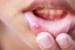 水溶C能治疗口腔溃疡吗