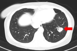 高烧℃肺部发霉竟因假期忽视这一细节