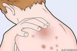 湿疹反复发作皮肤科医生教你科学管理