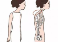 富贵包圆肩驼背有救了