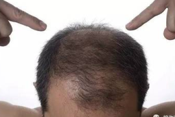 脱发后如何科学养护头发专家给出实用建议