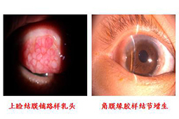 春季眼睛过敏奇痒难耐专家教你应对方法
