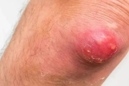 "这种红包又痛又肿硬挤很危险了解这些少跑医院"