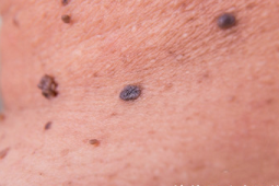 身上突然长小红点是什么原因会癌变吗