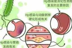 预防胃癌从远离幽门螺杆菌开始