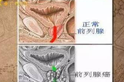 前列腺癌为何常在晚期才被发现