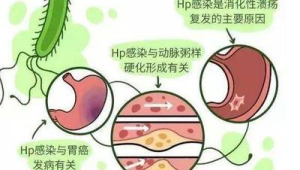 预防胃癌从远离幽门螺杆菌开始 第1张 预防胃癌从远离幽门螺杆菌开始 第1张