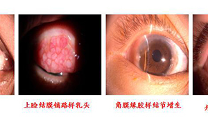春季眼睛过敏奇痒难耐专家教你应对方法  第1张
