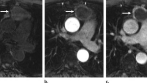 岁患者体内现厘米胸部肿瘤专家建议岁以上人群每年进行胸部CT检查 第1张 岁患者体内现厘米胸部肿瘤专家建议岁以上人群每年进行胸部CT检查 第1张