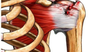 解码肩关节疼痛肩袖破裂还是肩周炎 第1张 解码肩关节疼痛肩袖破裂还是肩周炎 第1张