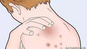 湿疹反复发作皮肤科医生教你科学管理 第1张 湿疹反复发作皮肤科医生教你科学管理 第1张