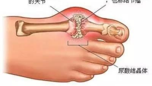 痛风祸根并非嘌呤我们对它的误解太深了 第1张 痛风祸根并非嘌呤我们对它的误解太深了 第1张