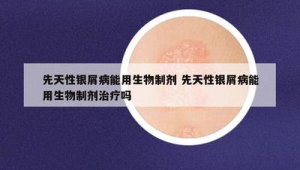 国产生物制剂为中重度斑块状银屑病患者提供新选择 第1张 国产生物制剂为中重度斑块状银屑病患者提供新选择 第1张