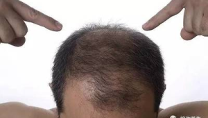 脱发后如何科学养护头发专家给出实用建议 第1张 脱发后如何科学养护头发专家给出实用建议 第1张