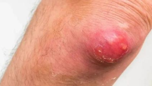 "这种红包又痛又肿硬挤很危险了解这些少跑医院" 第1张 "这种红包又痛又肿硬挤很危险了解这些少跑医院" 第1张