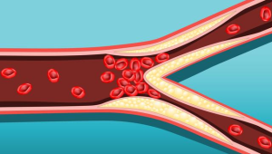 体检发现器官钙化就是大病征兆吗 第1张 体检发现器官钙化就是大病征兆吗 第1张