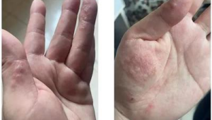 夏天手上长透明小水疱的原因及是否需要治疗 第1张 夏天手上长透明小水疱的原因及是否需要治疗 第1张