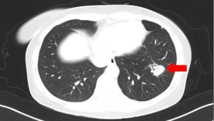 高烧℃肺部发霉竟因假期忽视这一细节 第1张 高烧℃肺部发霉竟因假期忽视这一细节 第1张