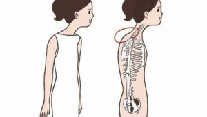 富贵包圆肩驼背有救了 第1张 富贵包圆肩驼背有救了 第1张