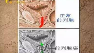 前列腺癌为何常在晚期才被发现 第1张 前列腺癌为何常在晚期才被发现 第1张